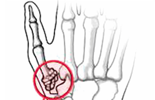 Thumb Arthritis